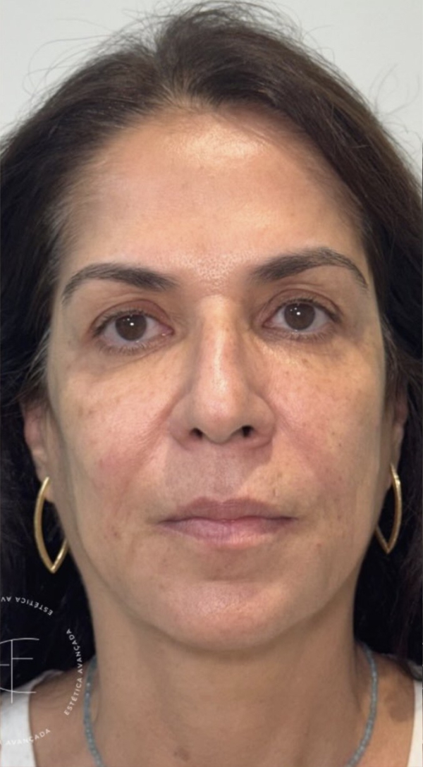 Depois — SkinLift
