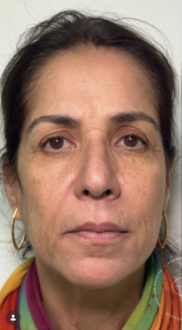 Antes — SkinLift