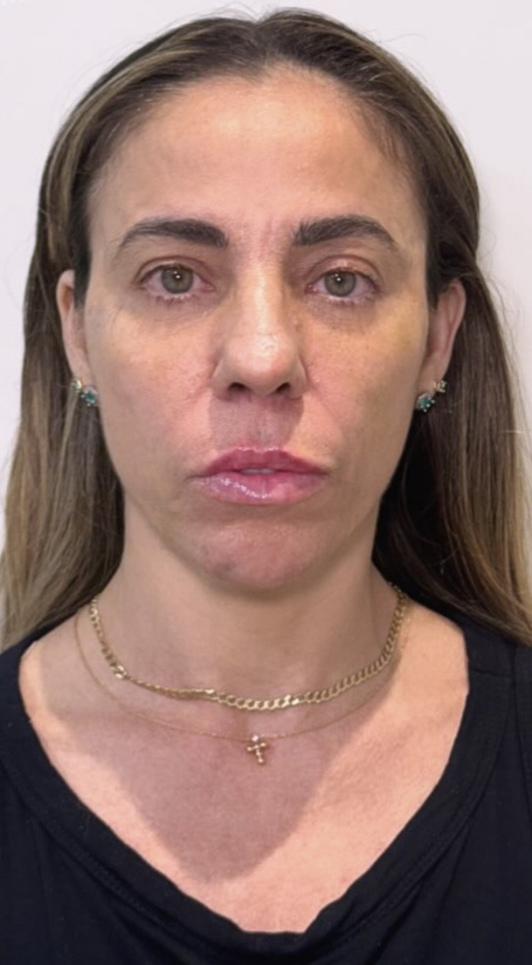 Depois — Harmonização Facial