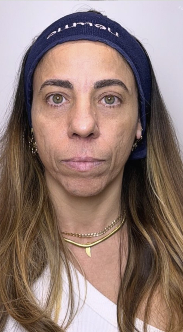 Antes — Harmonização Facial