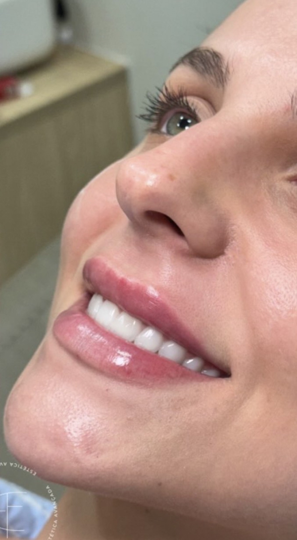 Depois — SkinSculpt Lips