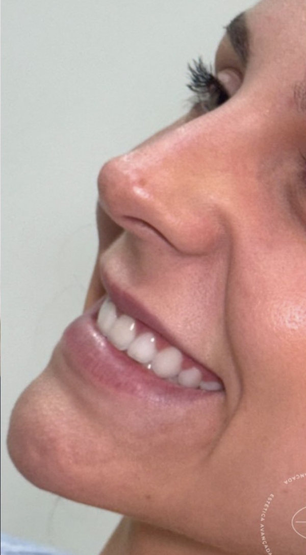 Antes — SkinSculpt Lips