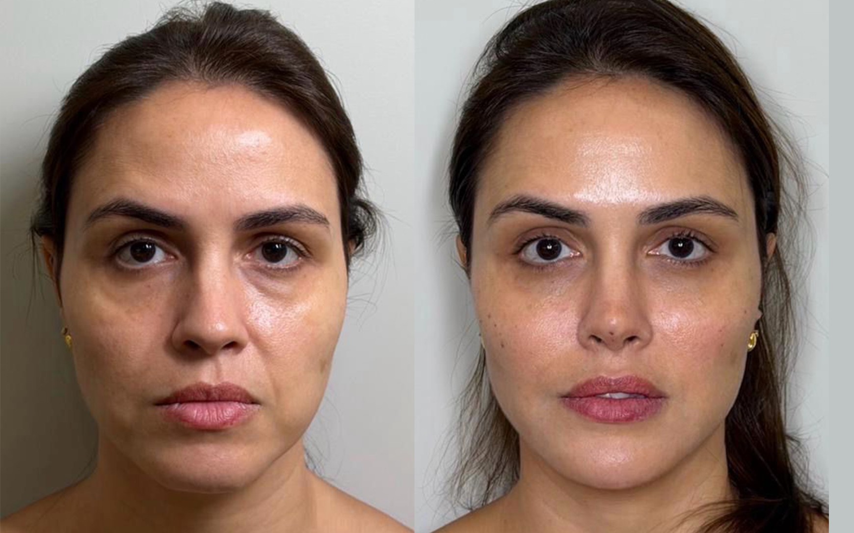 <i>Facial</i> Harmonização Facial