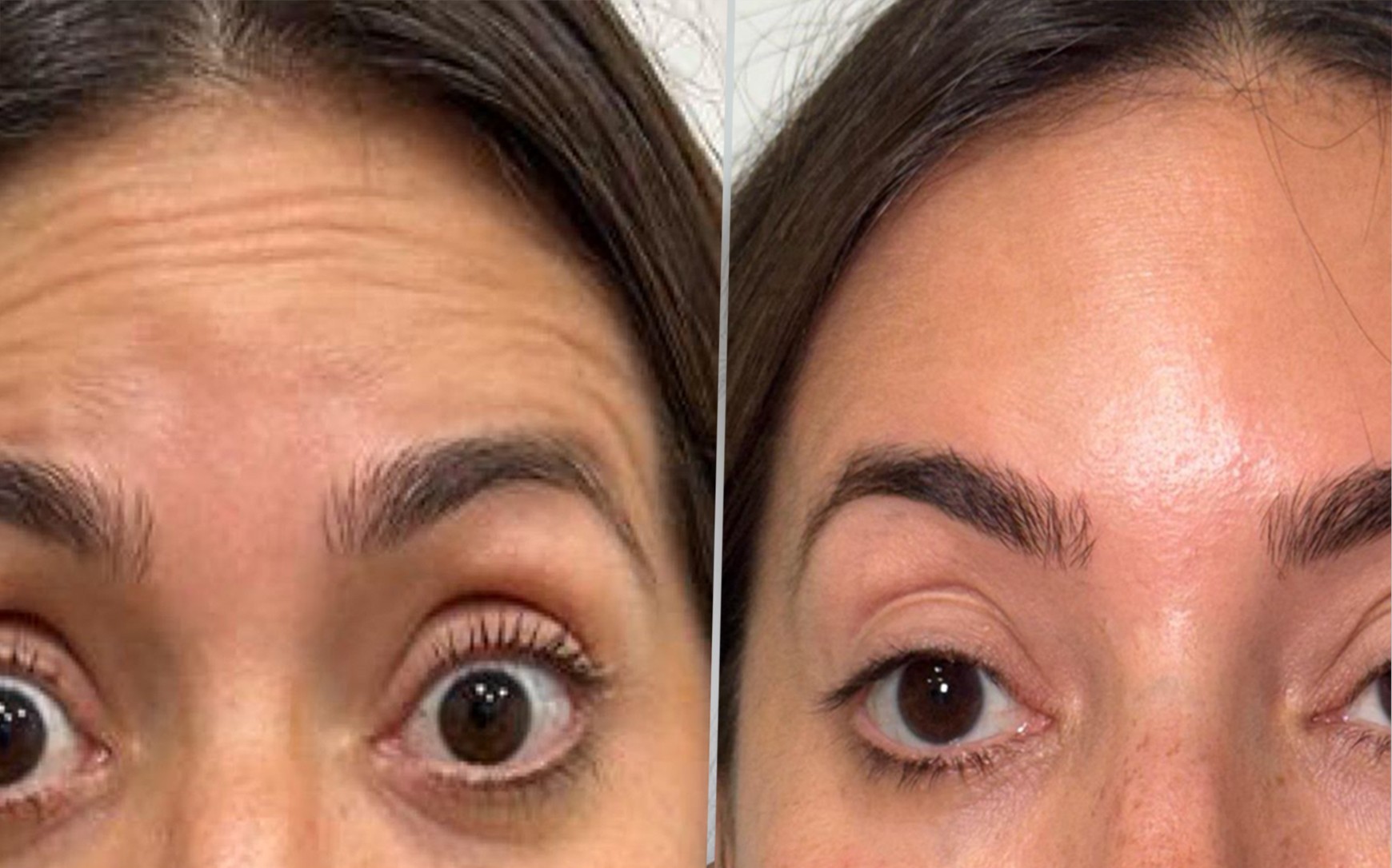 <i>Facial</i> Toxina Botulínica