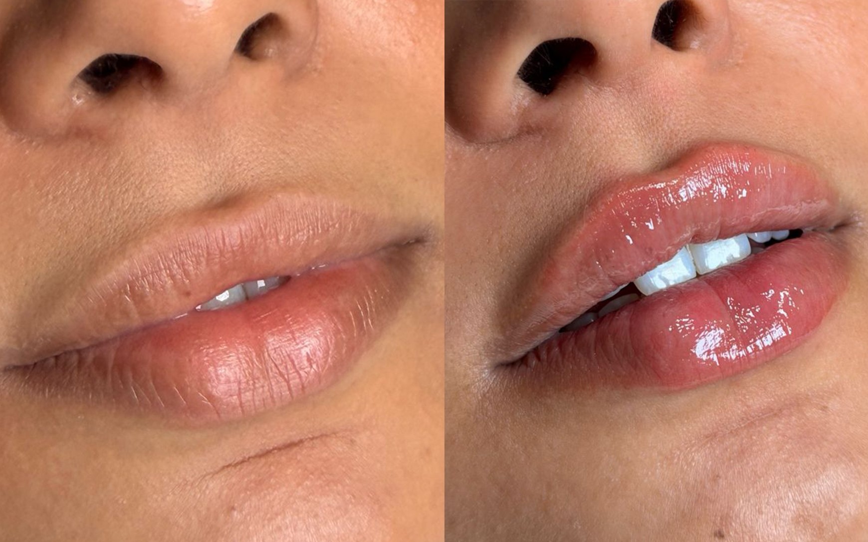 <i>Facial</i> Preenchimento com Ácido Hialurônico